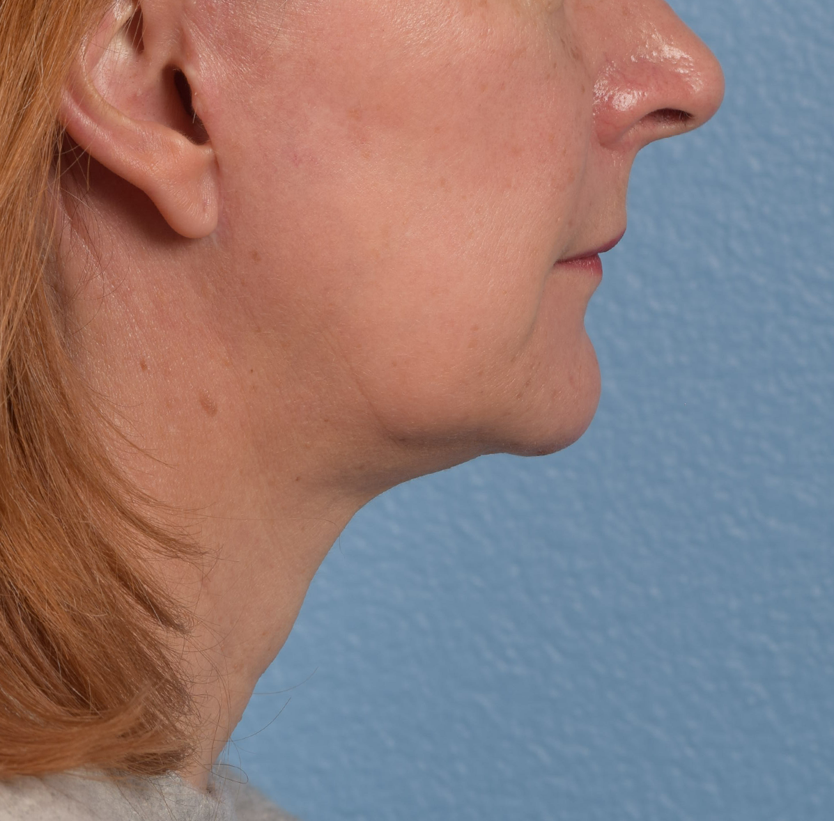 Neck Lift Before & After Gallery - Patient 204140 - Image 6