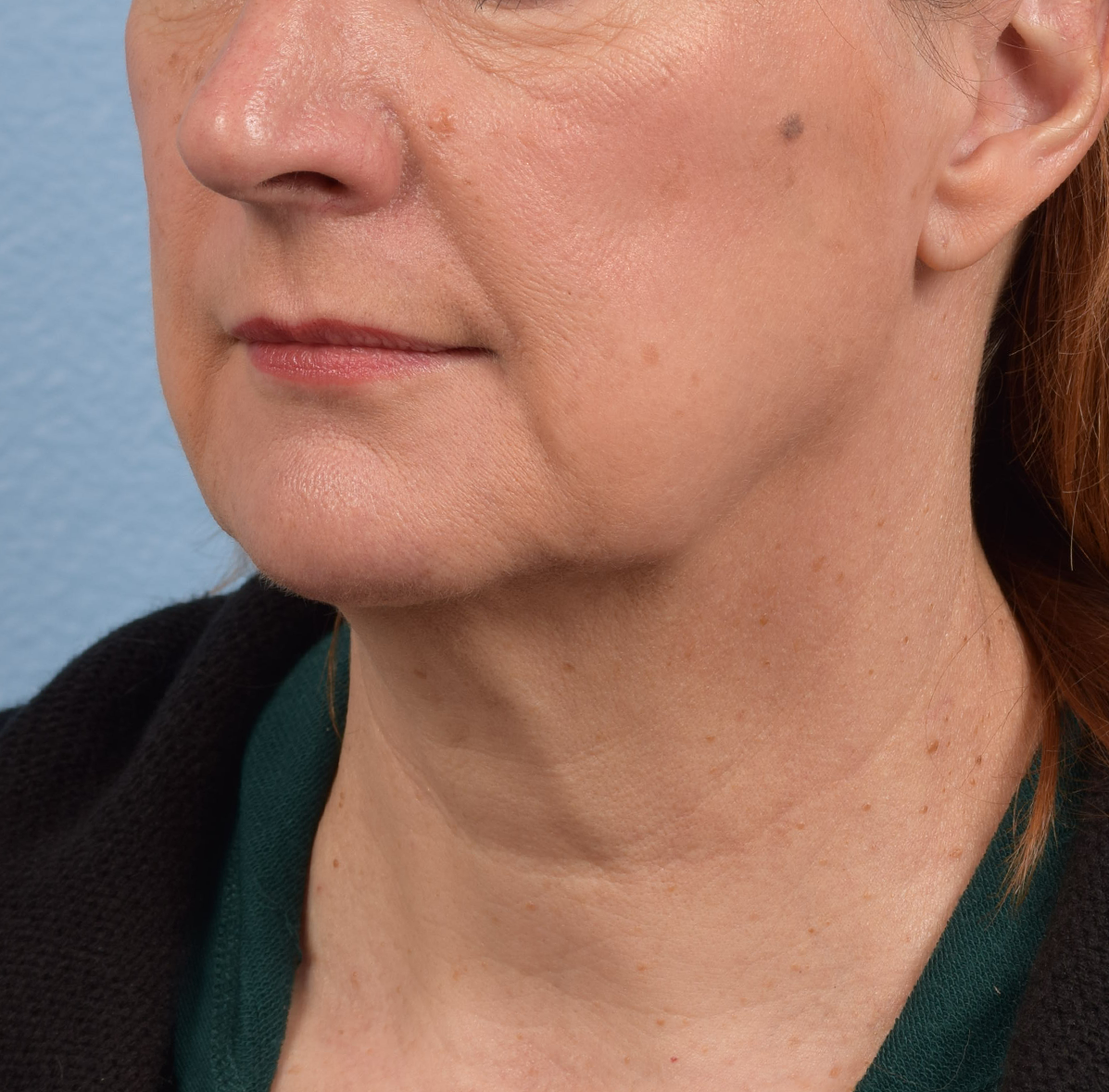 Neck Lift Before & After Gallery - Patient 204140 - Image 7
