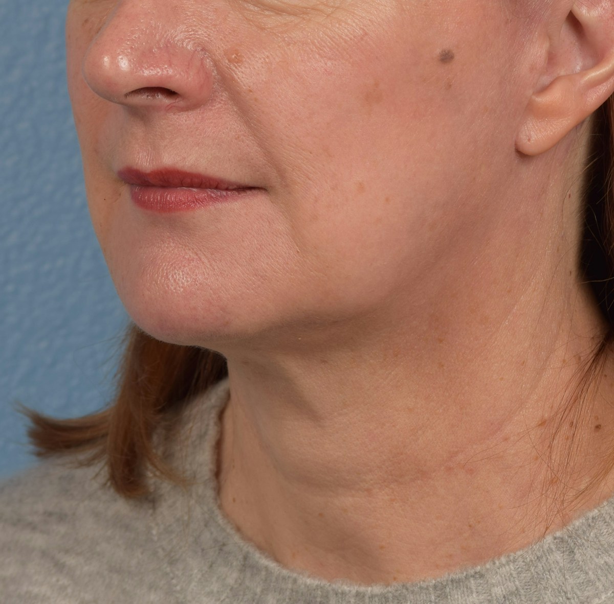Neck Lift Before & After Gallery - Patient 204140 - Image 8