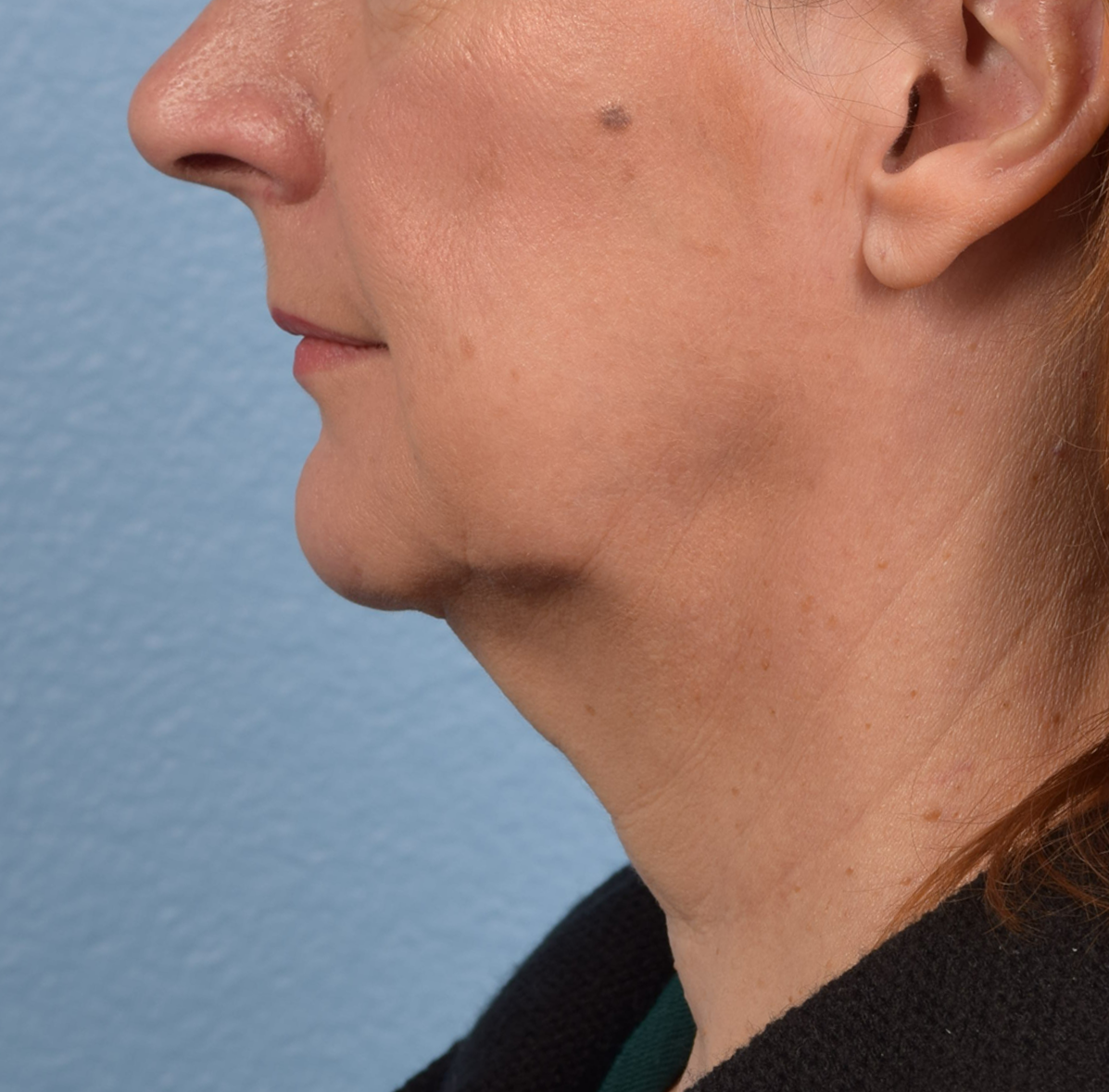 Neck Lift Before & After Gallery - Patient 204140 - Image 9