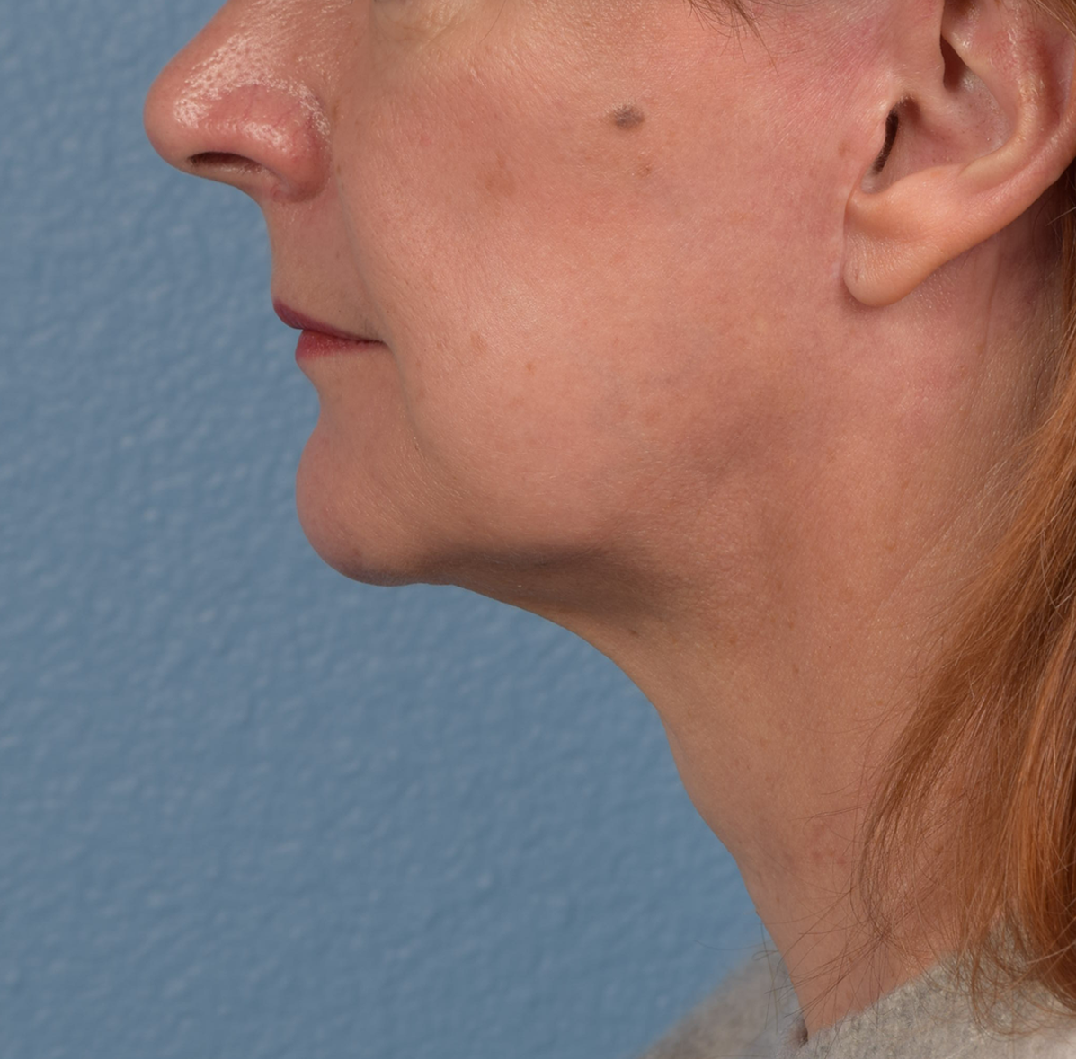 Neck Lift Before & After Gallery - Patient 204140 - Image 10