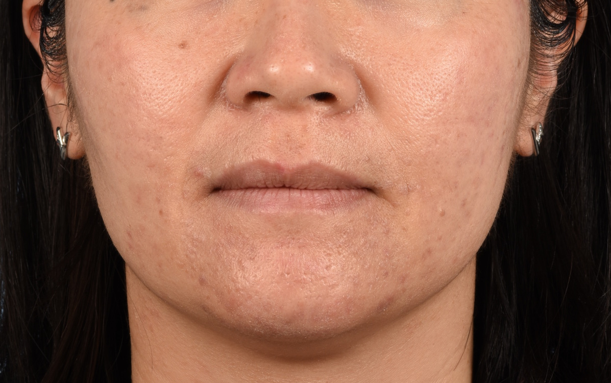 Hidden Patients Before & After Gallery - Patient 376097 - Image 1