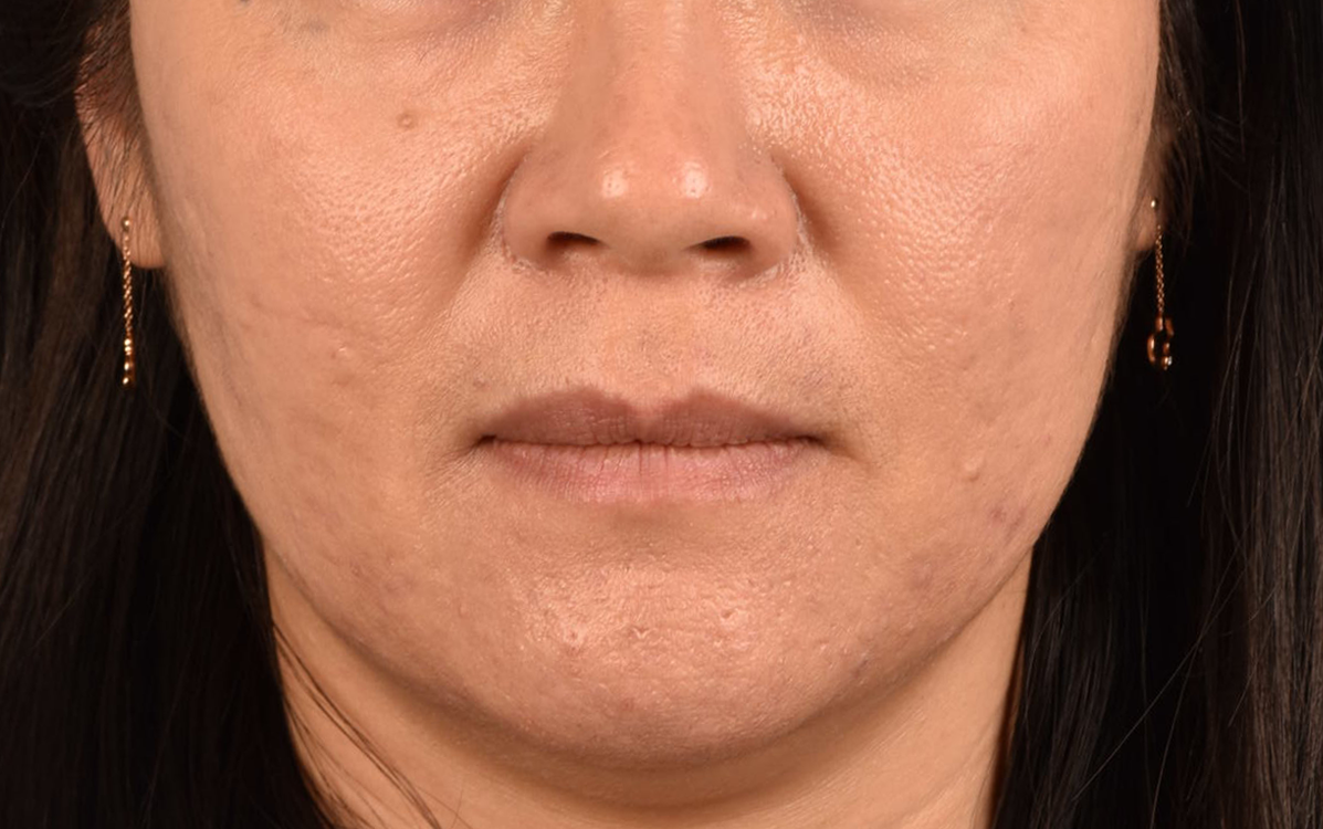 Hidden Patients Before & After Gallery - Patient 376097 - Image 2