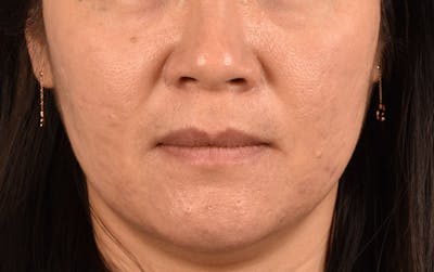 Chemical Peel Before & After Gallery - Patient 367318 - Image 2