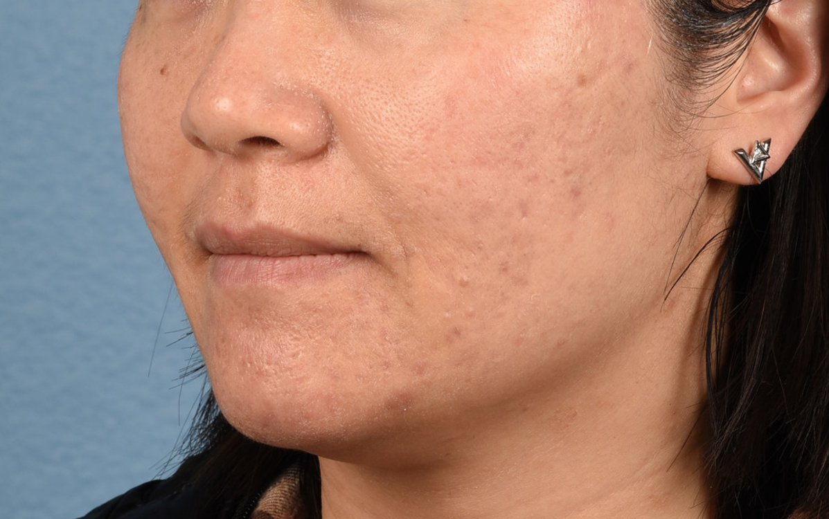 Hidden Patients Before & After Gallery - Patient 376097 - Image 3