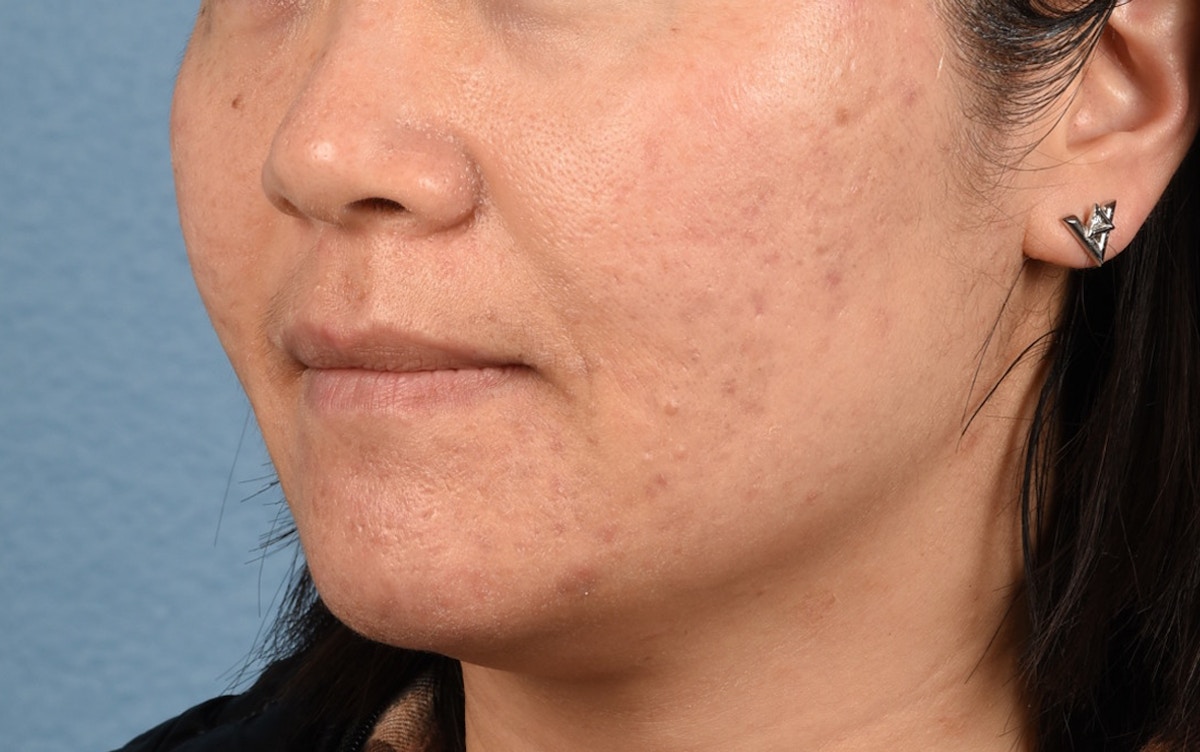 Chemical Peel Before & After Gallery - Patient 367318 - Image 3