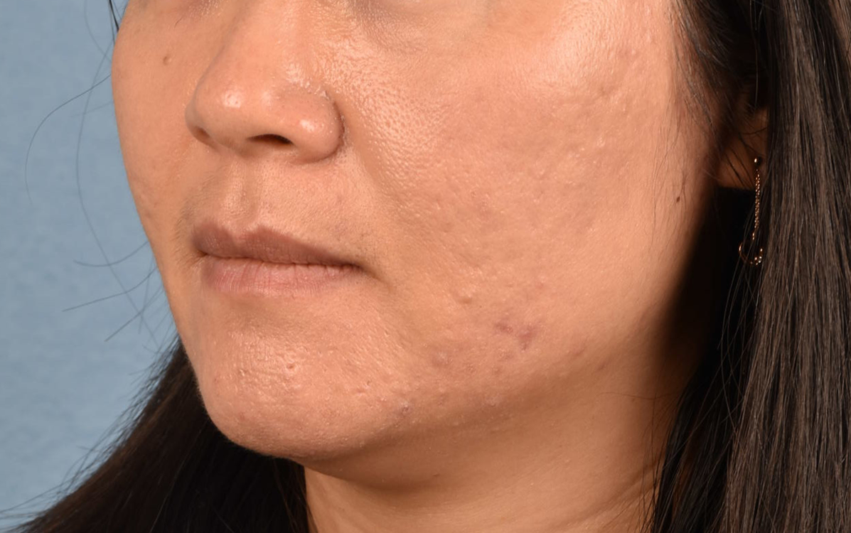 Hidden Patients Before & After Gallery - Patient 376097 - Image 4