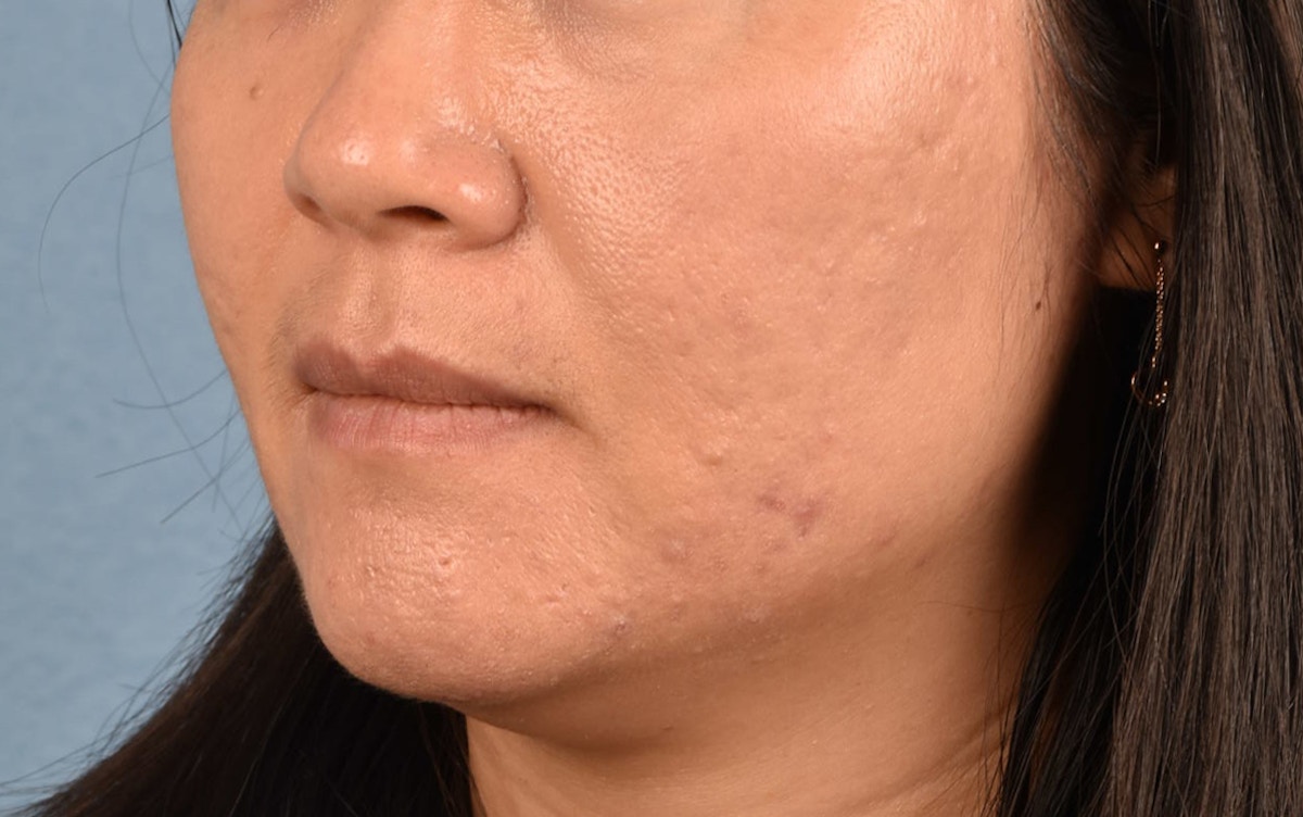 Chemical Peel Before & After Gallery - Patient 367318 - Image 4
