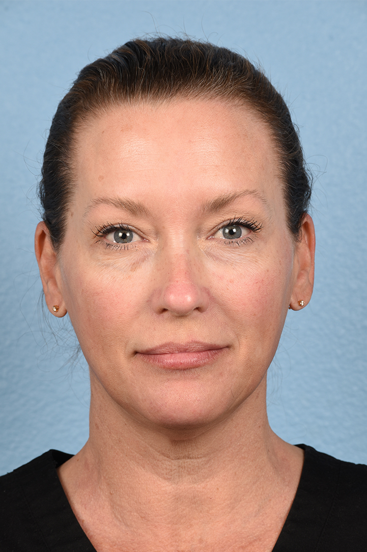 Hidden Patients Before & After Gallery - Patient 387658 - Image 1