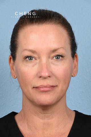 Hidden Patients Before & After Gallery - Patient 387658 - Image 1