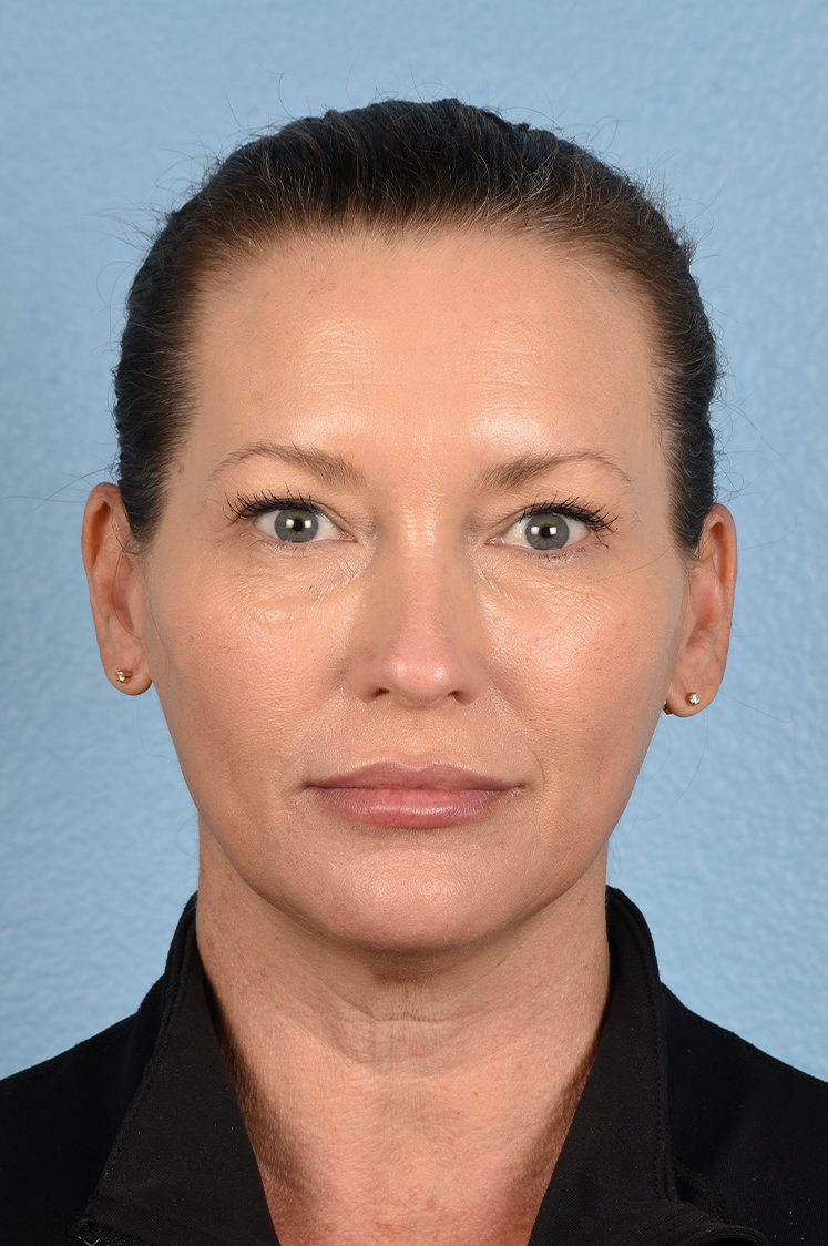 Hidden Patients Before & After Gallery - Patient 387658 - Image 2