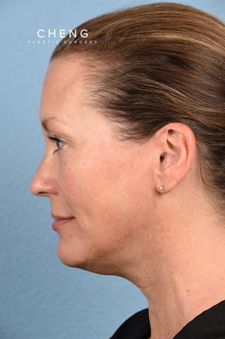 Hidden Patients Before & After Gallery - Patient 387658 - Image 3