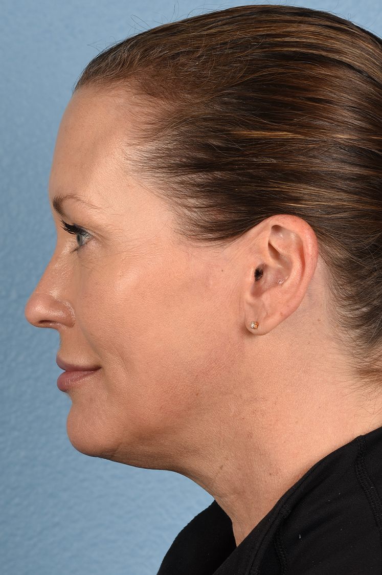 Hidden Patients Before & After Gallery - Patient 387658 - Image 4