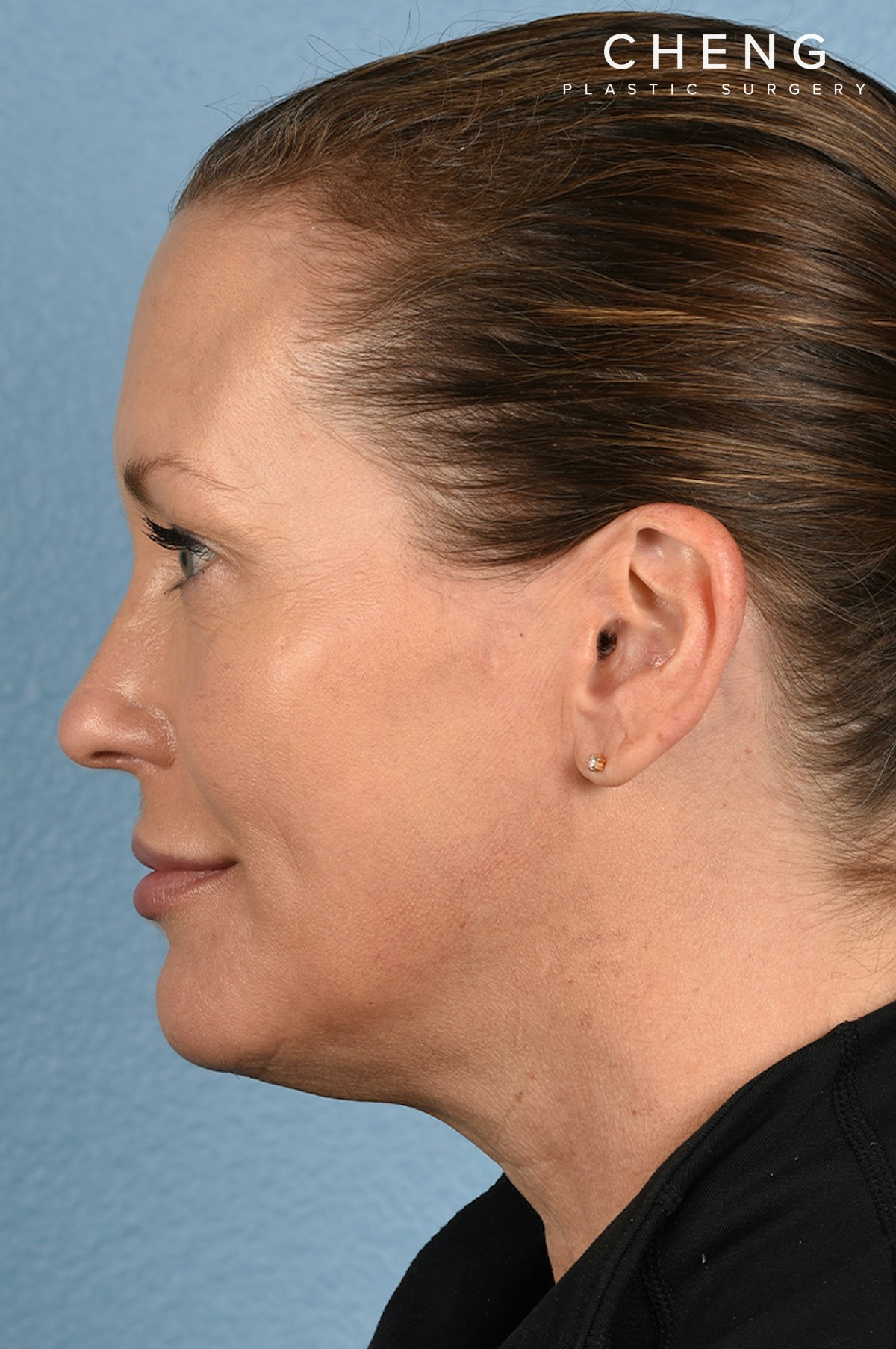 Hidden Patients Before & After Gallery - Patient 387658 - Image 4