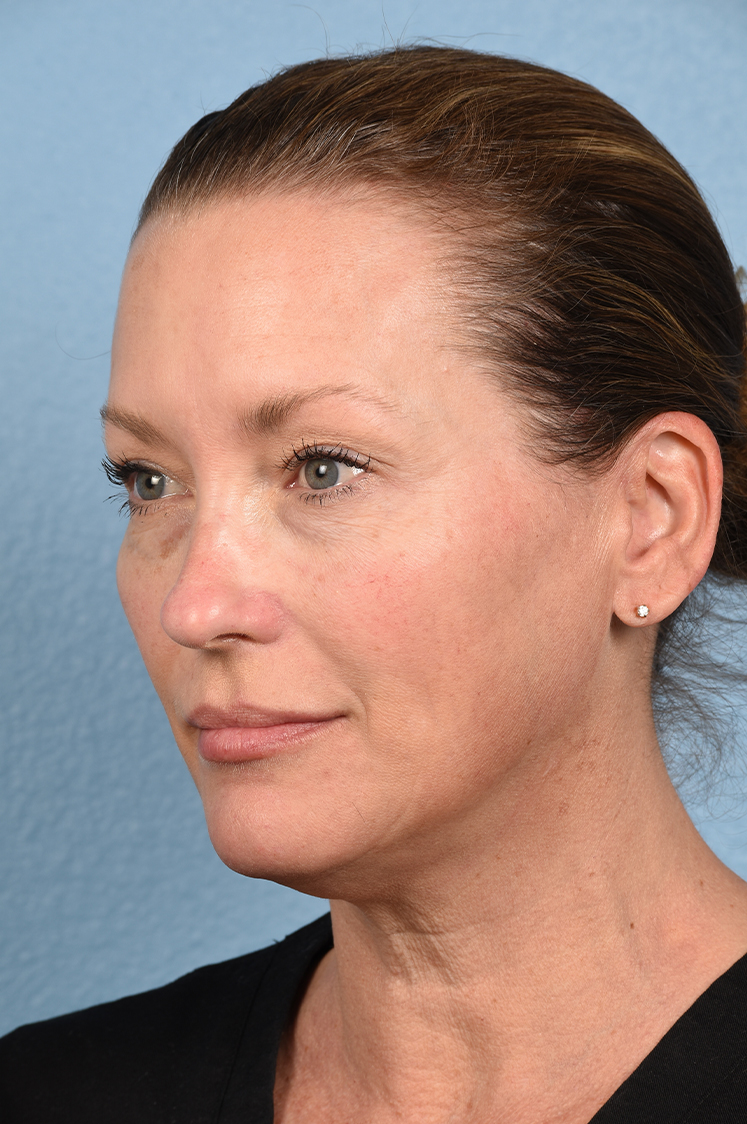 Hidden Patients Before & After Gallery - Patient 387658 - Image 5