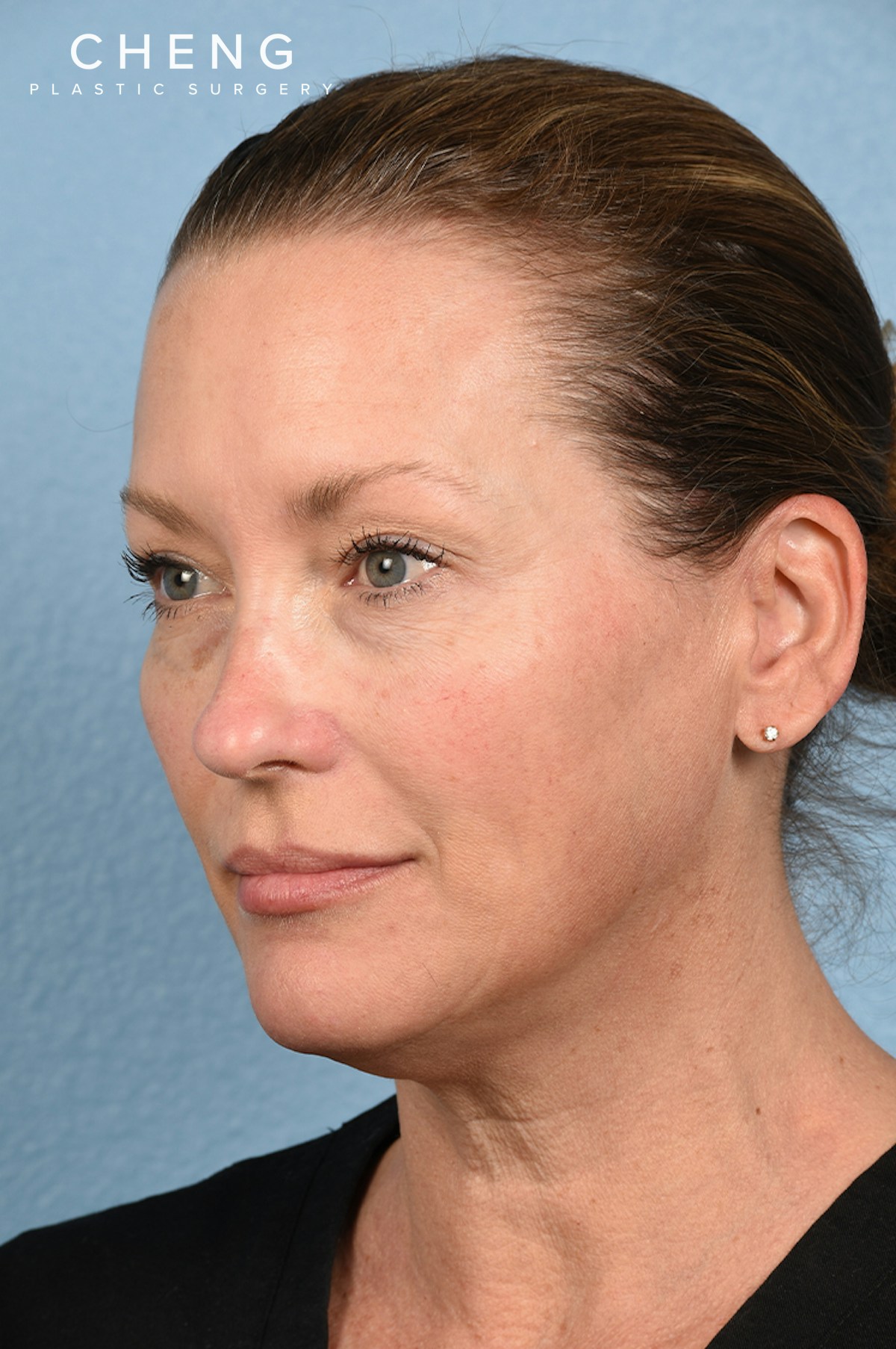 Hidden Patients Before & After Gallery - Patient 387658 - Image 5