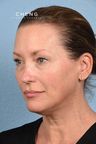 Hidden Patients Before & After Gallery - Patient 387658 - Image 5