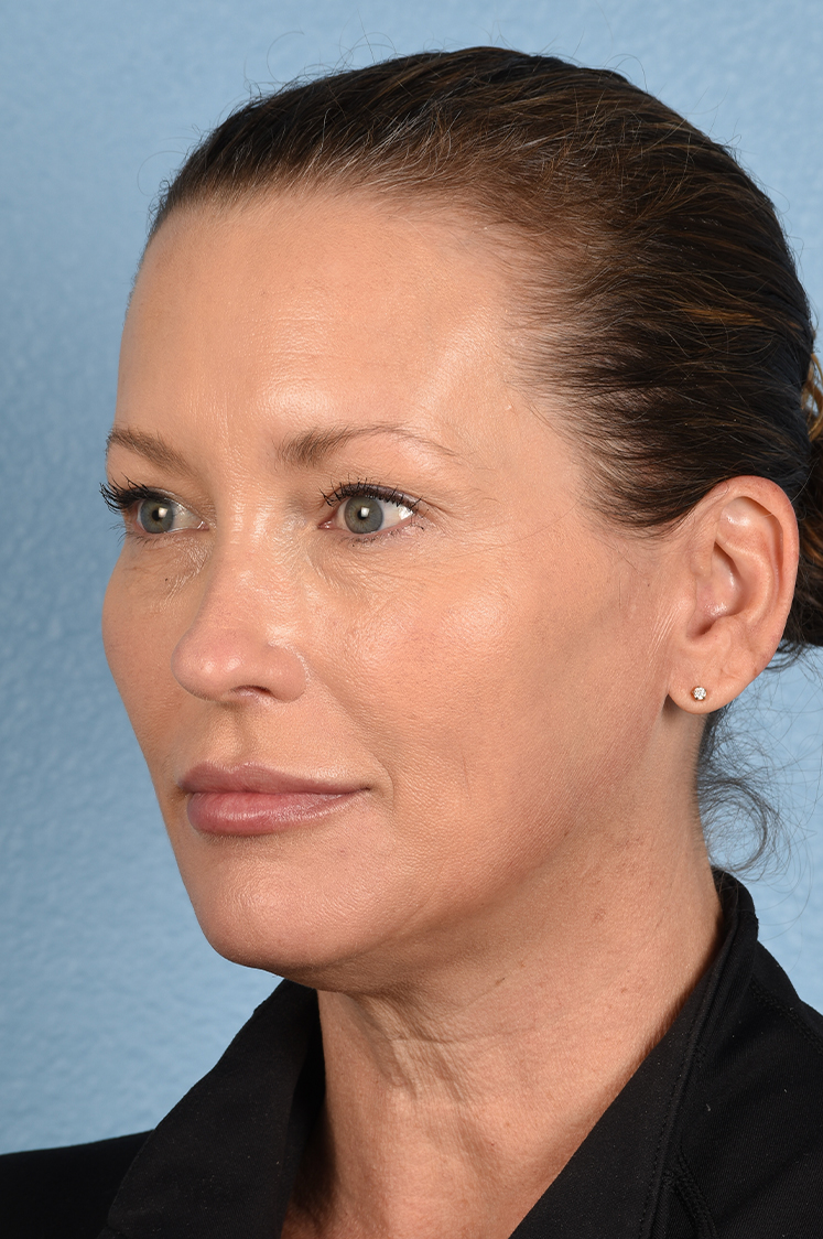 Hidden Patients Before & After Gallery - Patient 387658 - Image 6