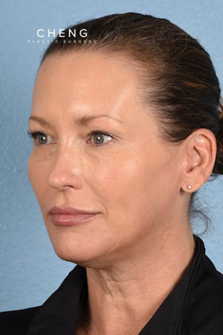 Hidden Patients Before & After Gallery - Patient 387658 - Image 6