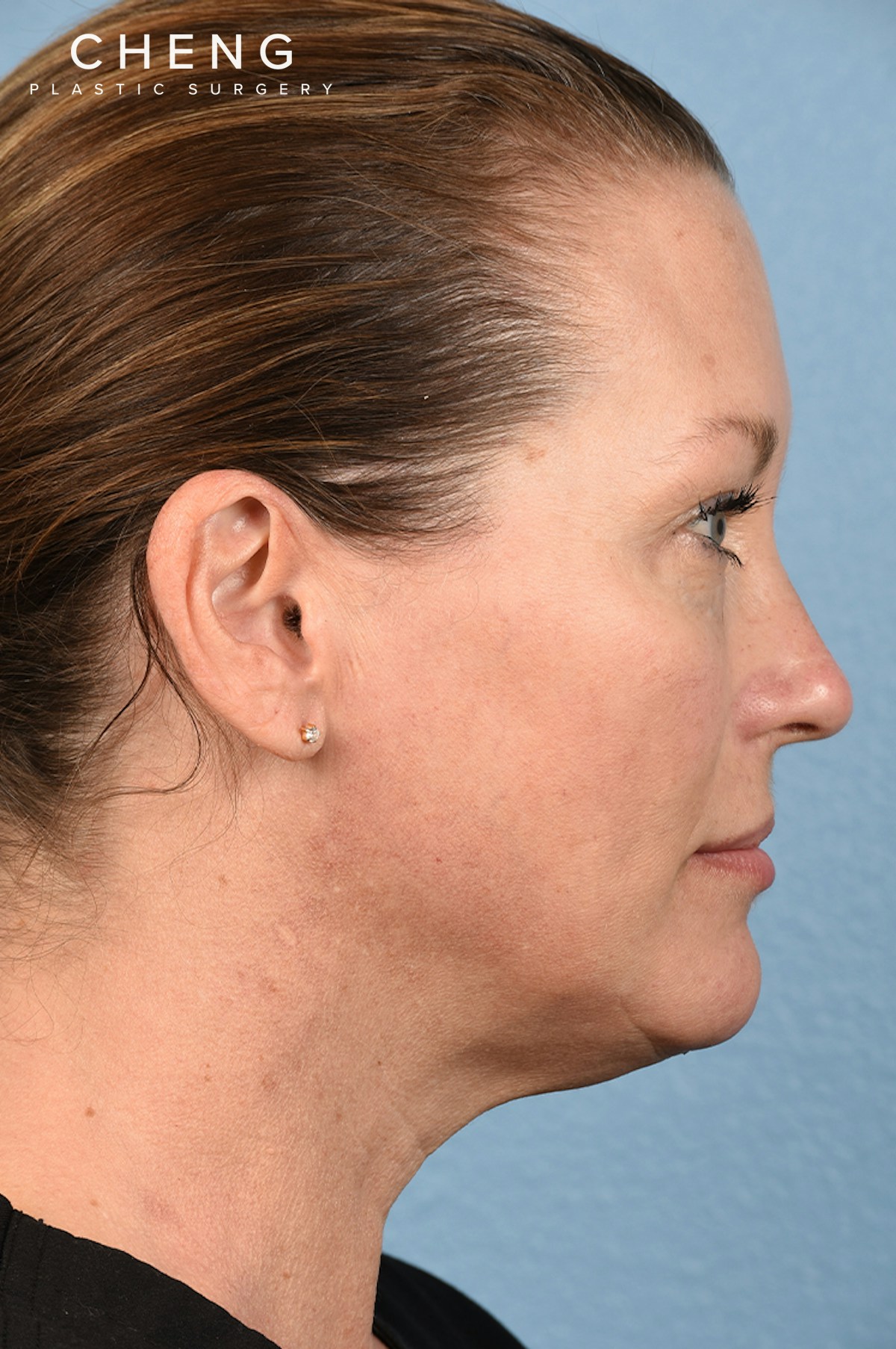 Hidden Patients Before & After Gallery - Patient 387658 - Image 7