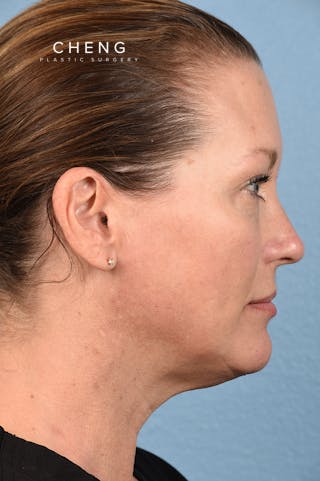Hidden Patients Before & After Gallery - Patient 387658 - Image 7