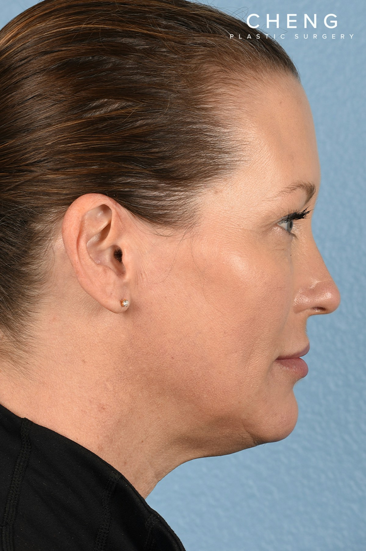 Hidden Patients Before & After Gallery - Patient 387658 - Image 8