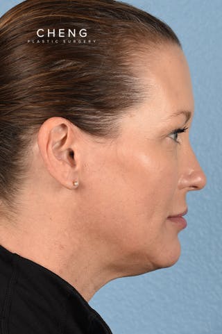 Hidden Patients Before & After Gallery - Patient 387658 - Image 8