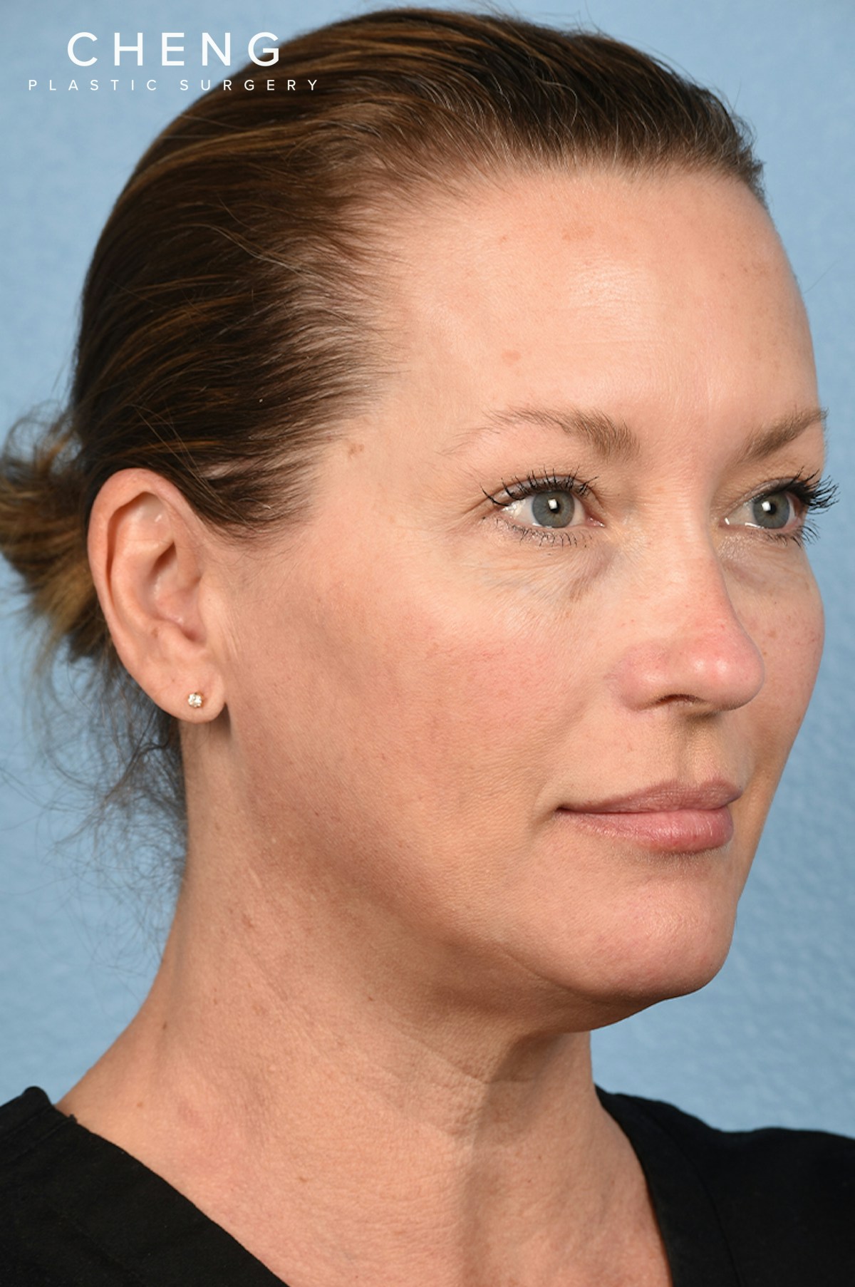 Hidden Patients Before & After Gallery - Patient 387658 - Image 9