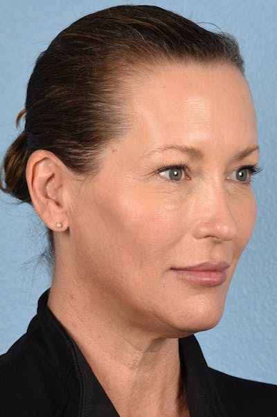 Dermal Fillers Before & After Gallery - Patient 311543 - Image 2