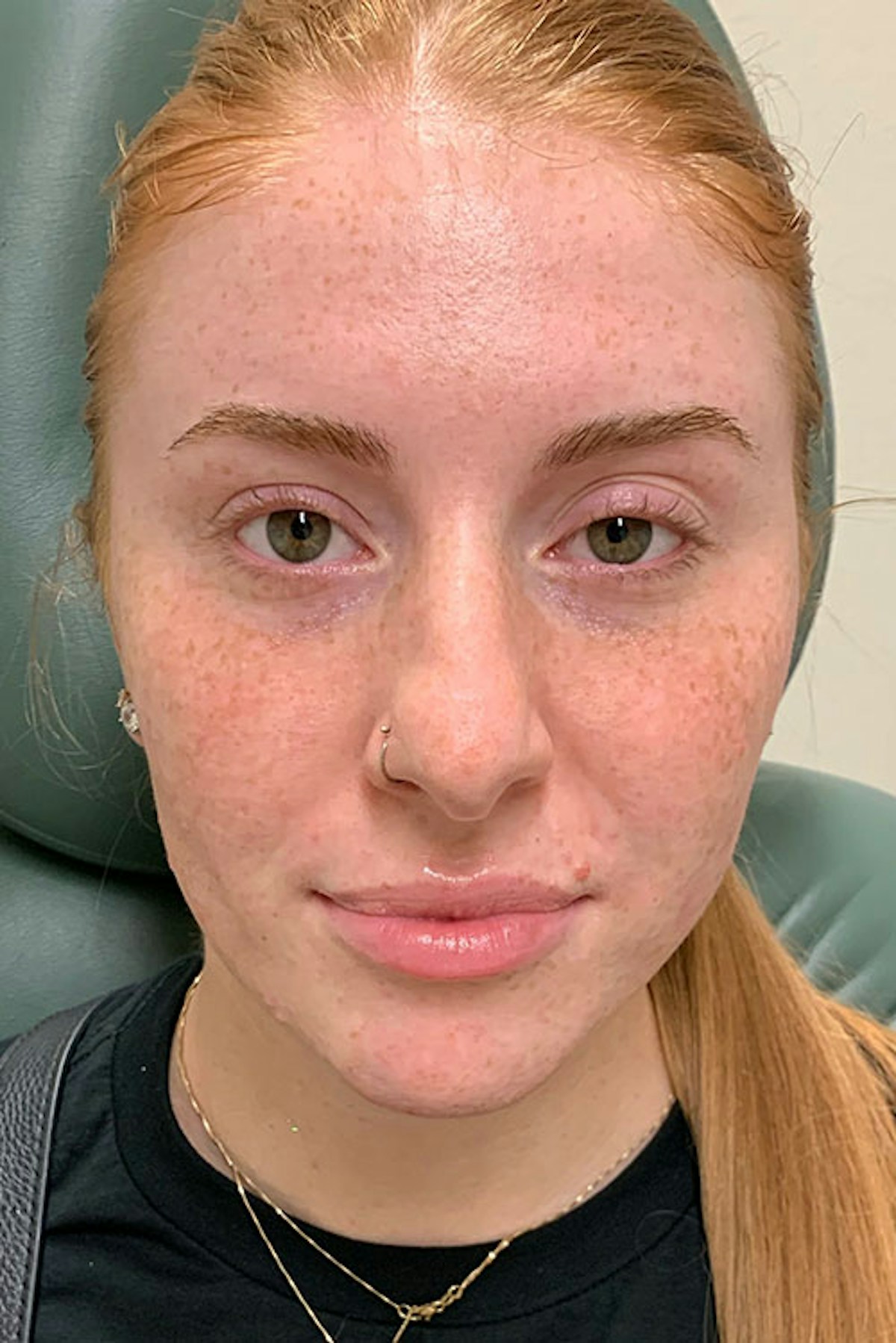 Lip Fillers Before & After Gallery - Patient 328550 - Image 1