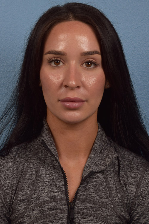 Hidden Patients Before & After Gallery - Patient 725234 - Image 2