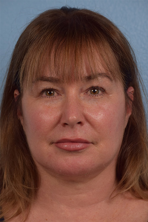 Hidden Patients Before & After Gallery - Patient 302703 - Image 2