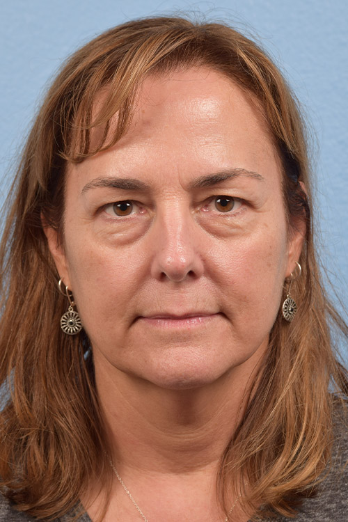 Hidden Patients Before & After Gallery - Patient 177329 - Image 1