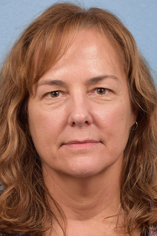 Hidden Patients Before & After Gallery - Patient 177329 - Image 2