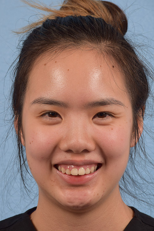 Hidden Patients Before & After Gallery - Patient 391679 - Image 1