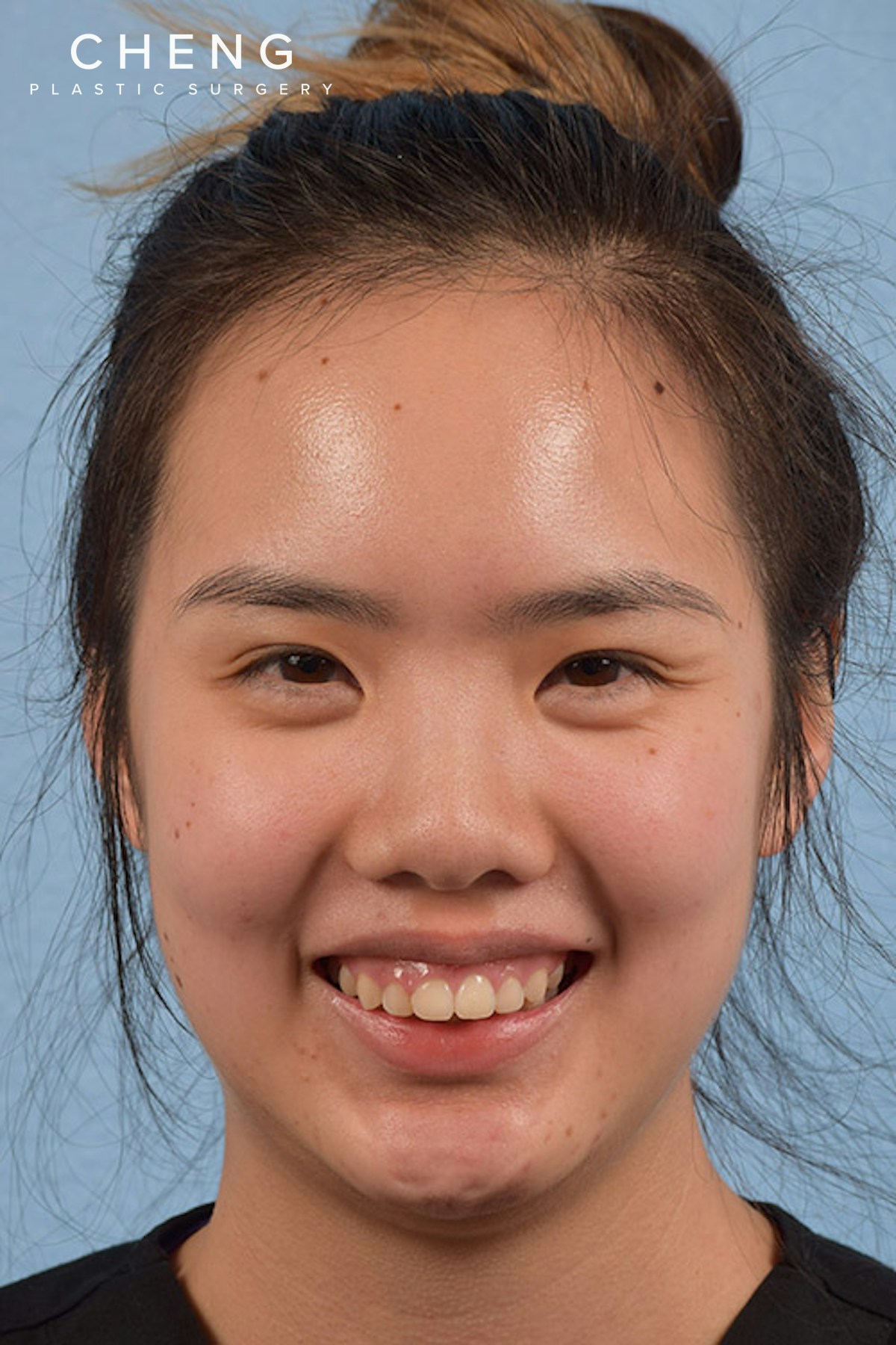 Hidden Patients Before & After Gallery - Patient 199848 - Image 1