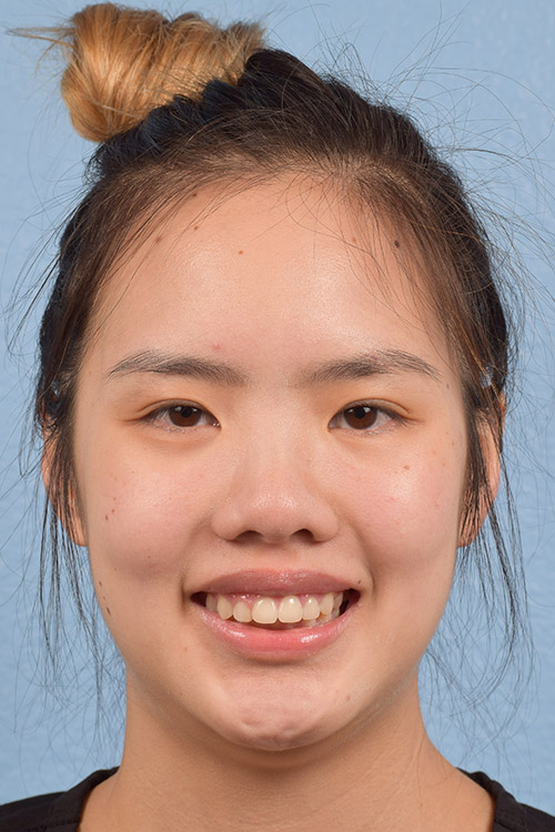 Hidden Patients Before & After Gallery - Patient 391679 - Image 2