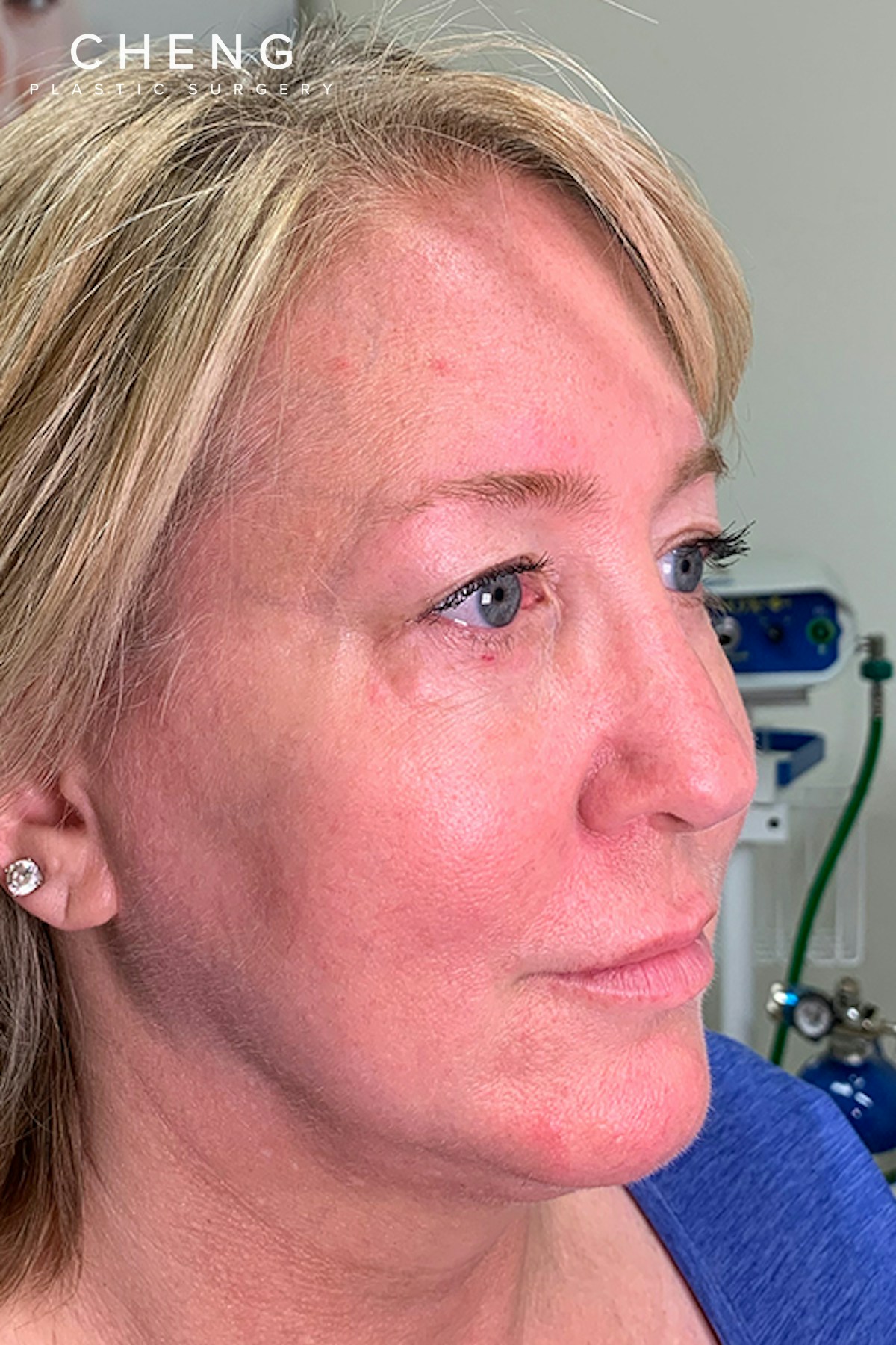 Hidden Patients Before & After Gallery - Patient 176343 - Image 1