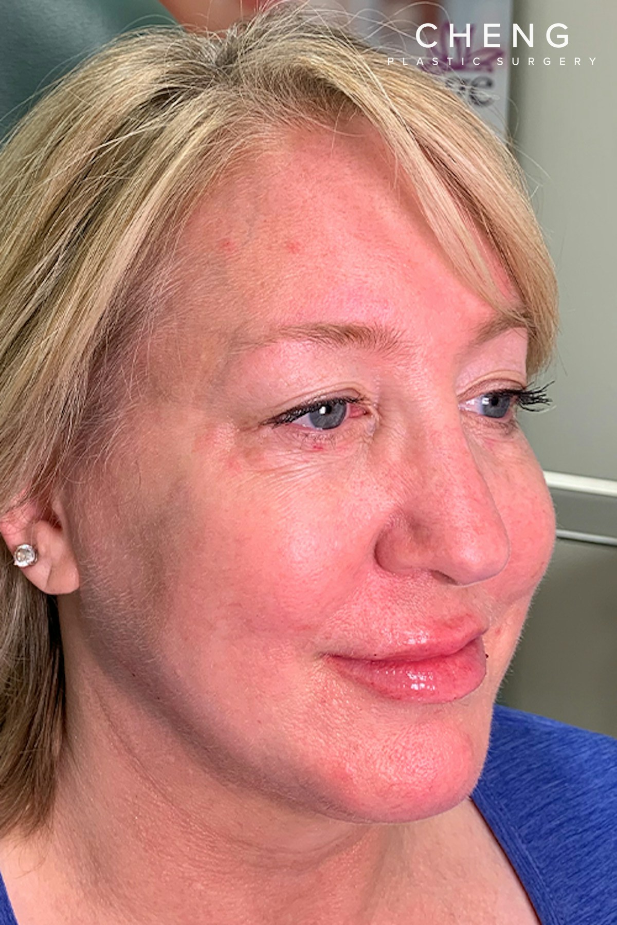 Hidden Patients Before & After Gallery - Patient 176343 - Image 2