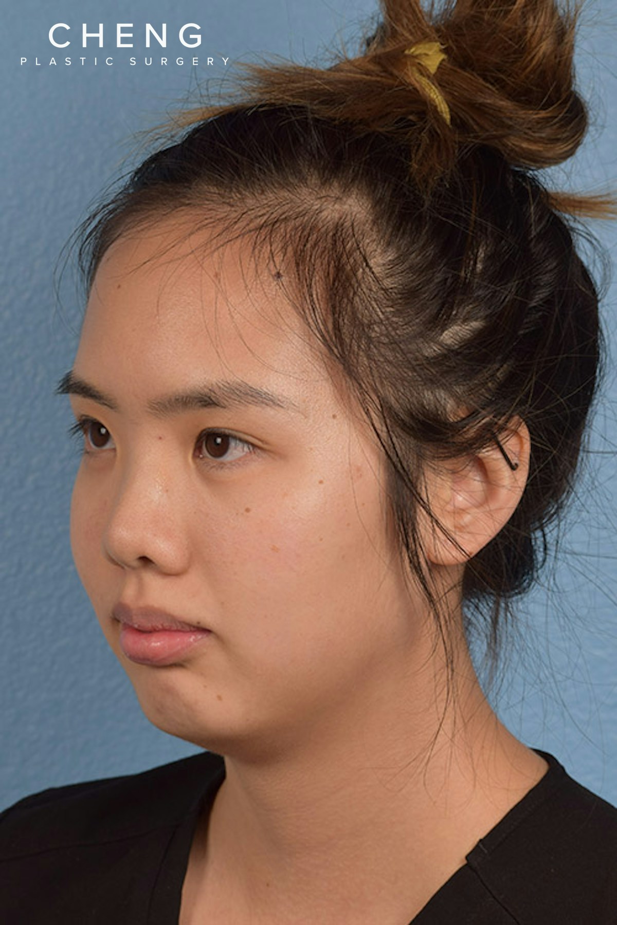 Hidden Patients Before & After Gallery - Patient 197760 - Image 1