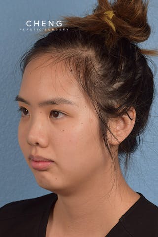 Hidden Patients Before & After Gallery - Patient 197760 - Image 1