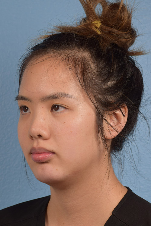 Hidden Patients Before & After Gallery - Patient 180833 - Image 2