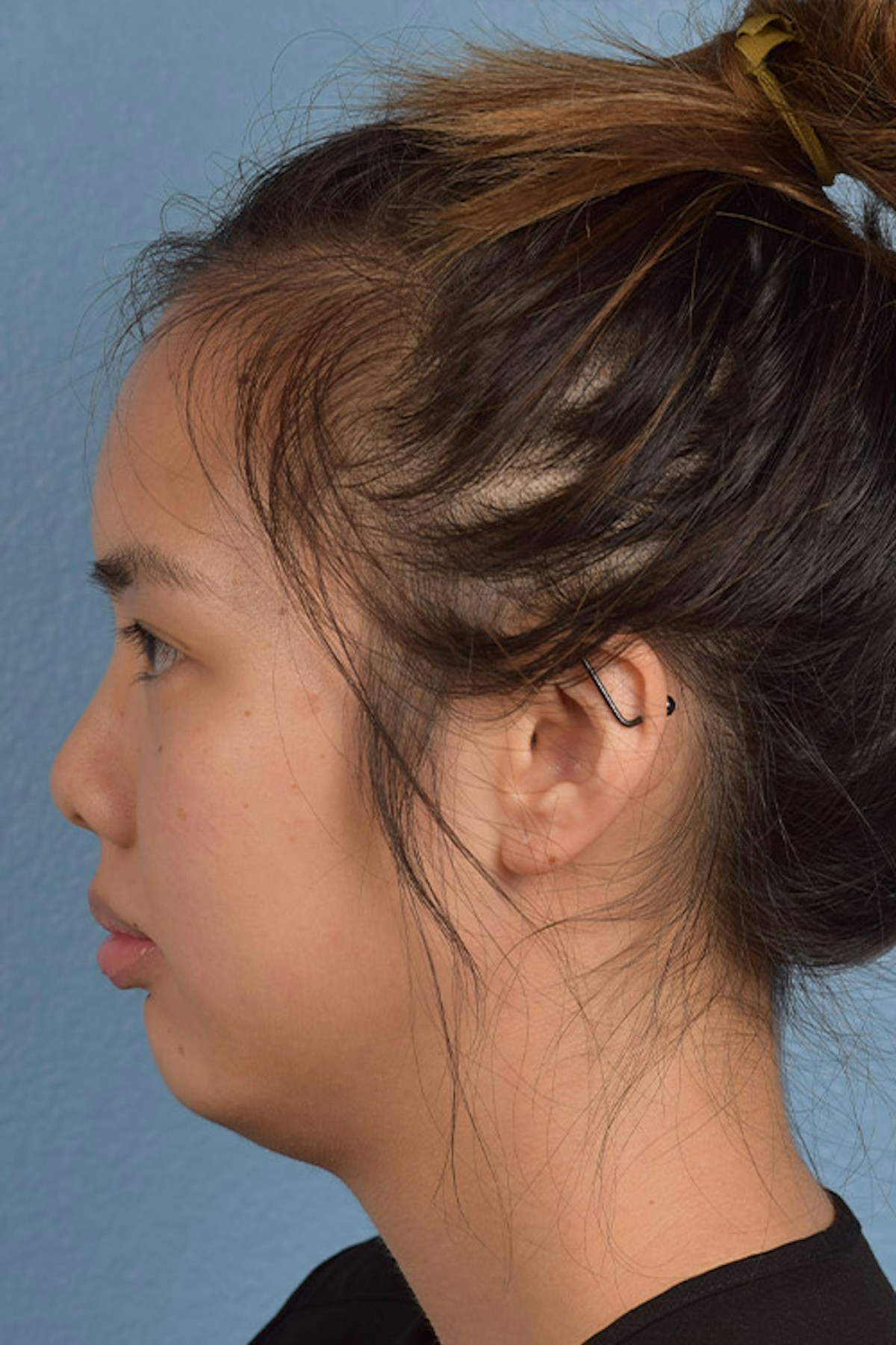 Injectables Before & After Gallery - Patient 633028 - Image 3