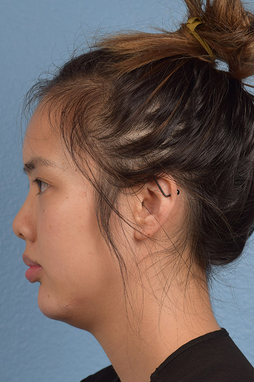 Hidden Patients Before & After Gallery - Patient 180833 - Image 4