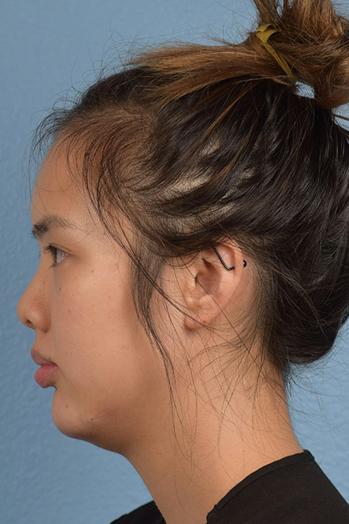 Injectables Before & After Gallery - Patient 633028 - Image 4