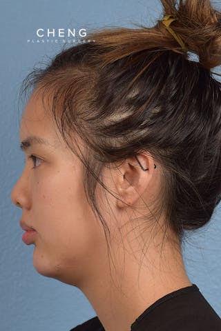 Hidden Patients Before & After Gallery - Patient 197760 - Image 4