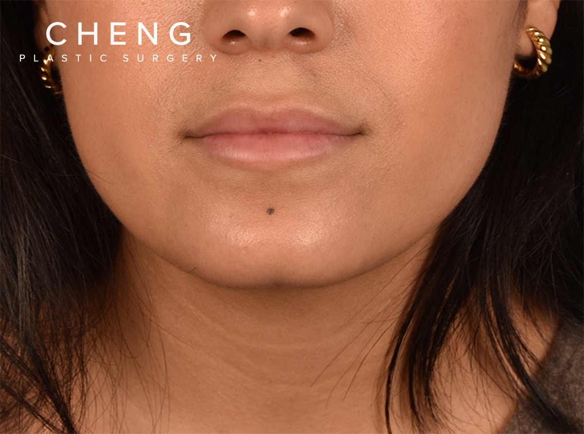 Hidden Patients Before & After Gallery - Patient 708681 - Image 1