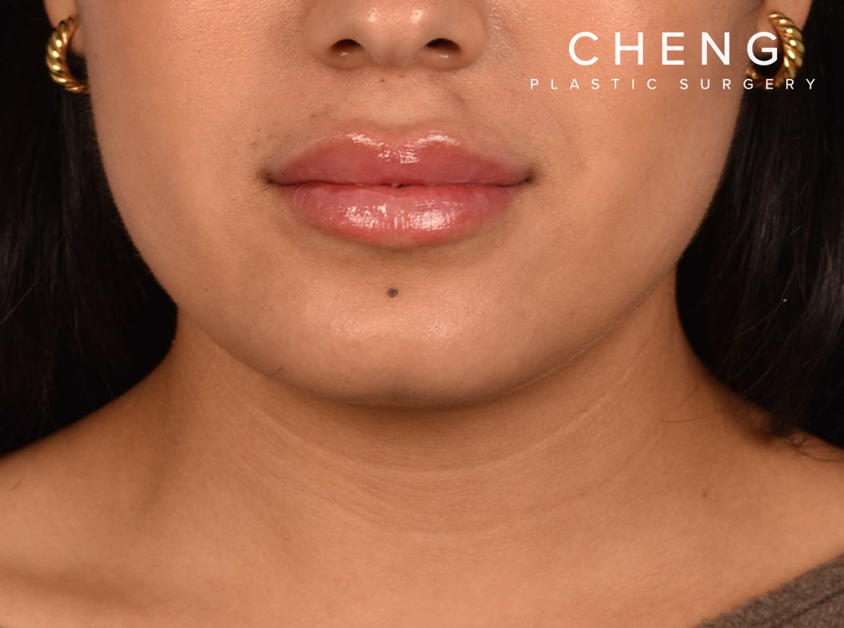 Hidden Patients Before & After Gallery - Patient 708681 - Image 2