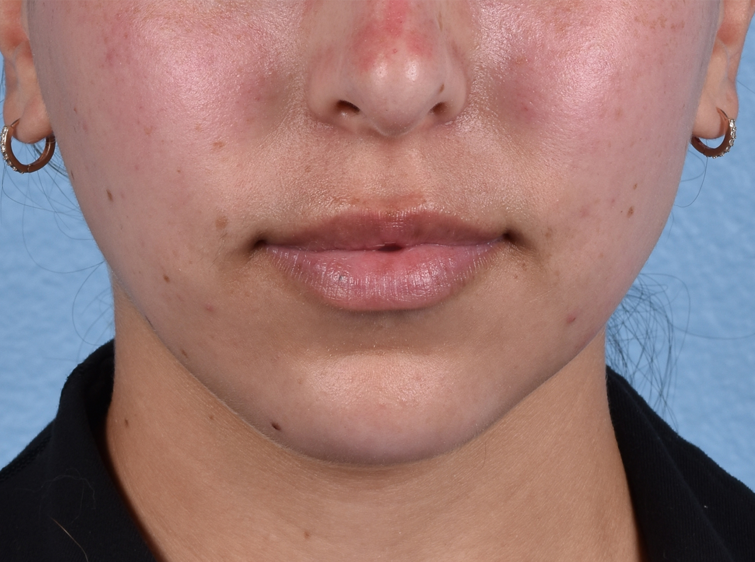 Hidden Patients Before & After Gallery - Patient 230925 - Image 1
