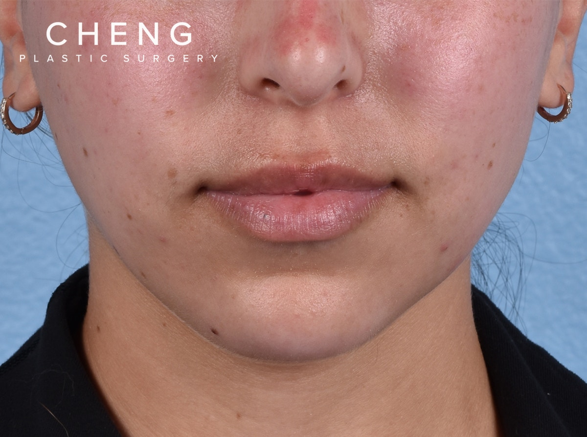 Hidden Patients Before & After Gallery - Patient 230925 - Image 1